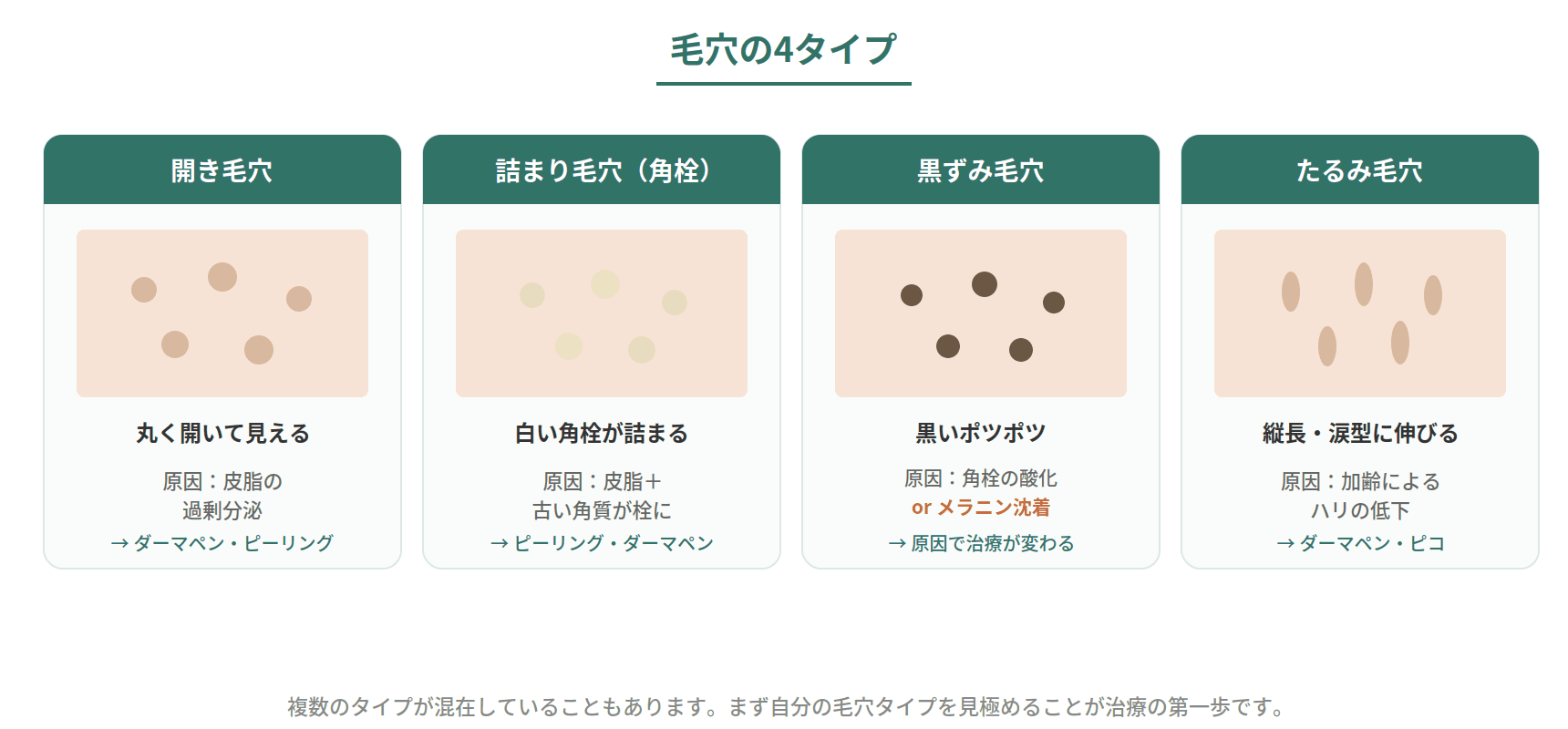 毛穴の悩みを開き毛穴・詰まり毛穴・黒ずみ毛穴・たるみ毛穴の4タイプに分けて見た目と原因を比較した図