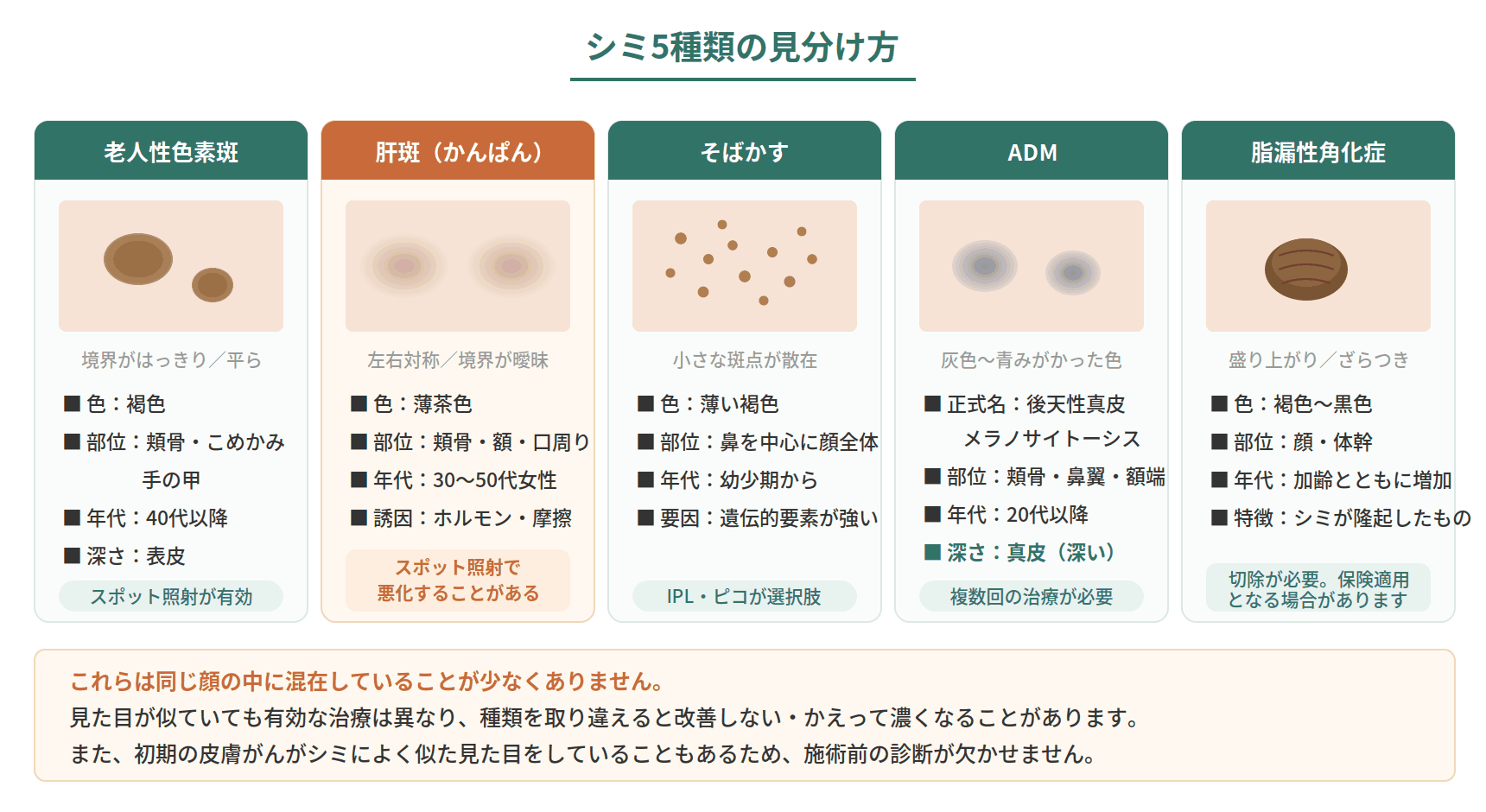老人性色素斑・肝斑・そばかす・ADM・脂漏性角化症の5種類のシミの見た目と好発部位を比較した図解