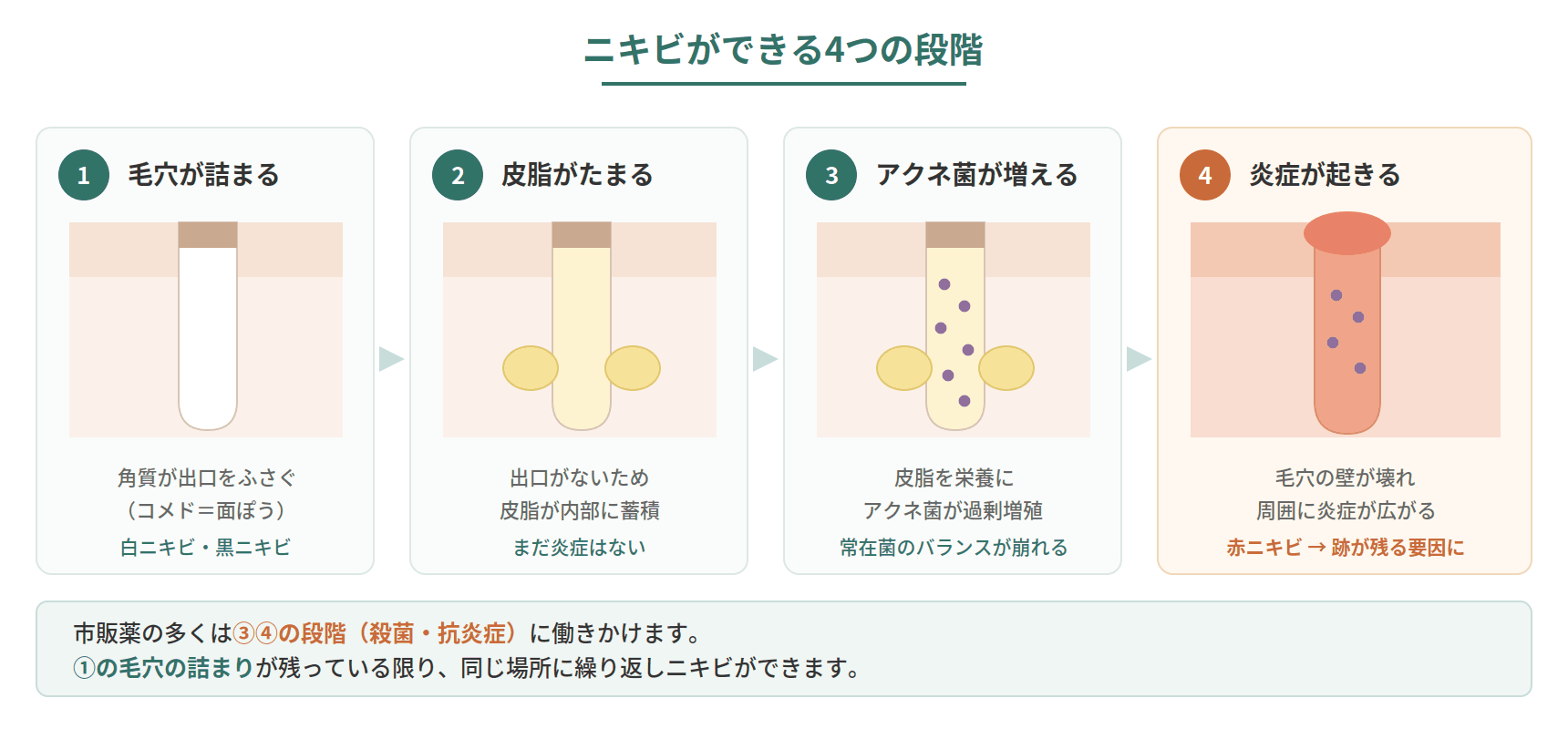 ニキビができる4つの段階を示した毛穴の断面図解。毛穴の詰まり、皮脂の蓄積、アクネ菌の増殖、炎症の順に進む