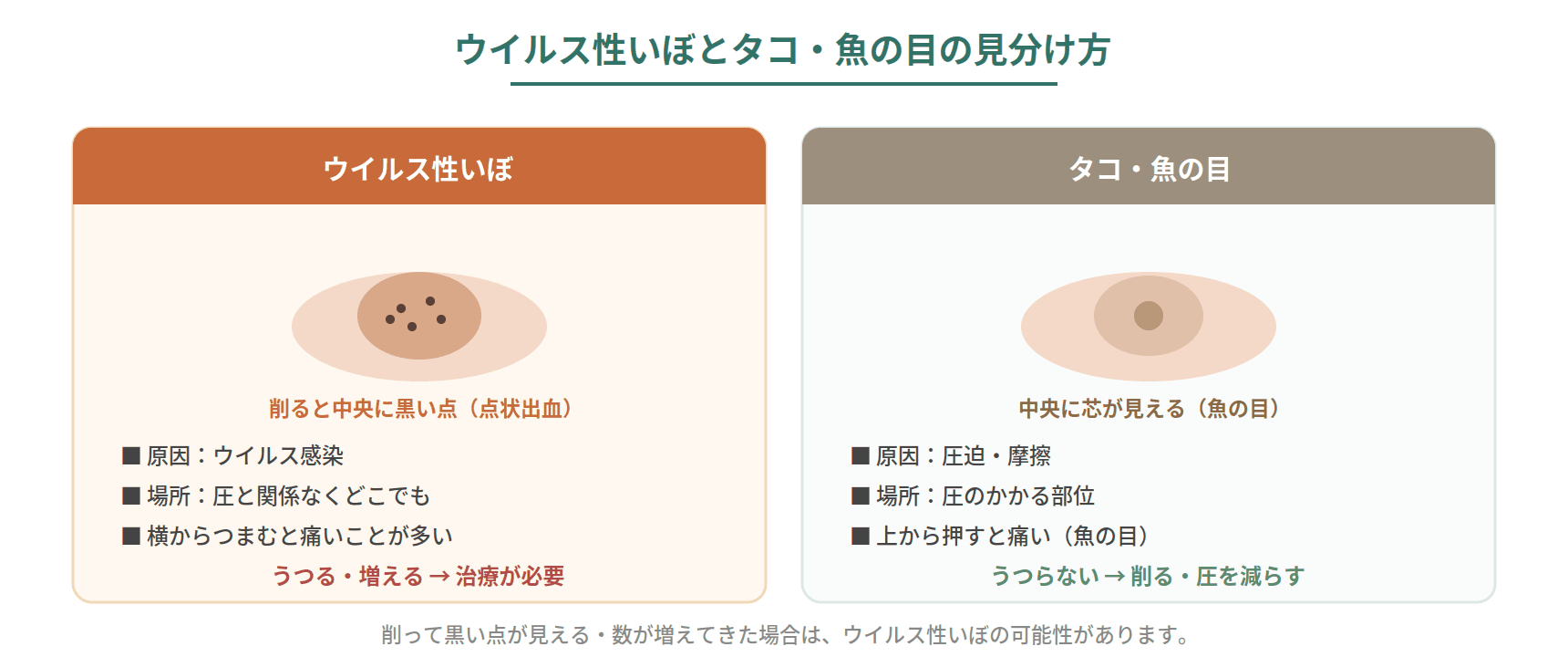 ウイルス性いぼとタコ・魚の目の見分け方を、原因・削ったときの見え方・うつるかどうかで比較した図