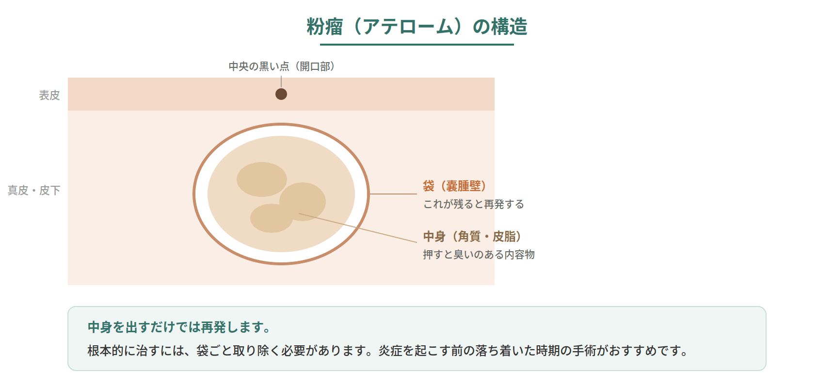 粉瘤の断面図。皮膚の下に袋があり中に角質がたまる構造と、袋ごと取り除く必要があることを示した図