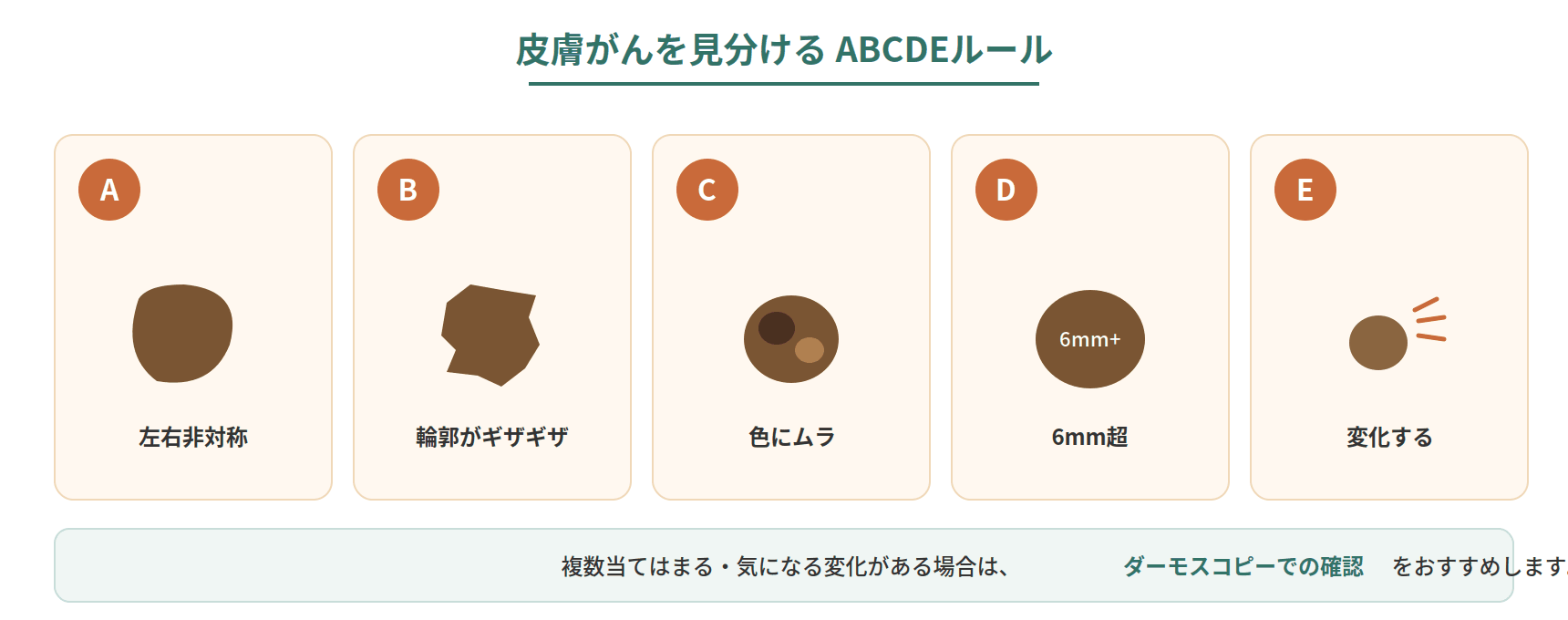 皮膚がんを見分けるABCDEルールを、左右非対称・輪郭・色ムラ・大きさ・変化の5点で良性のほくろと比較した図