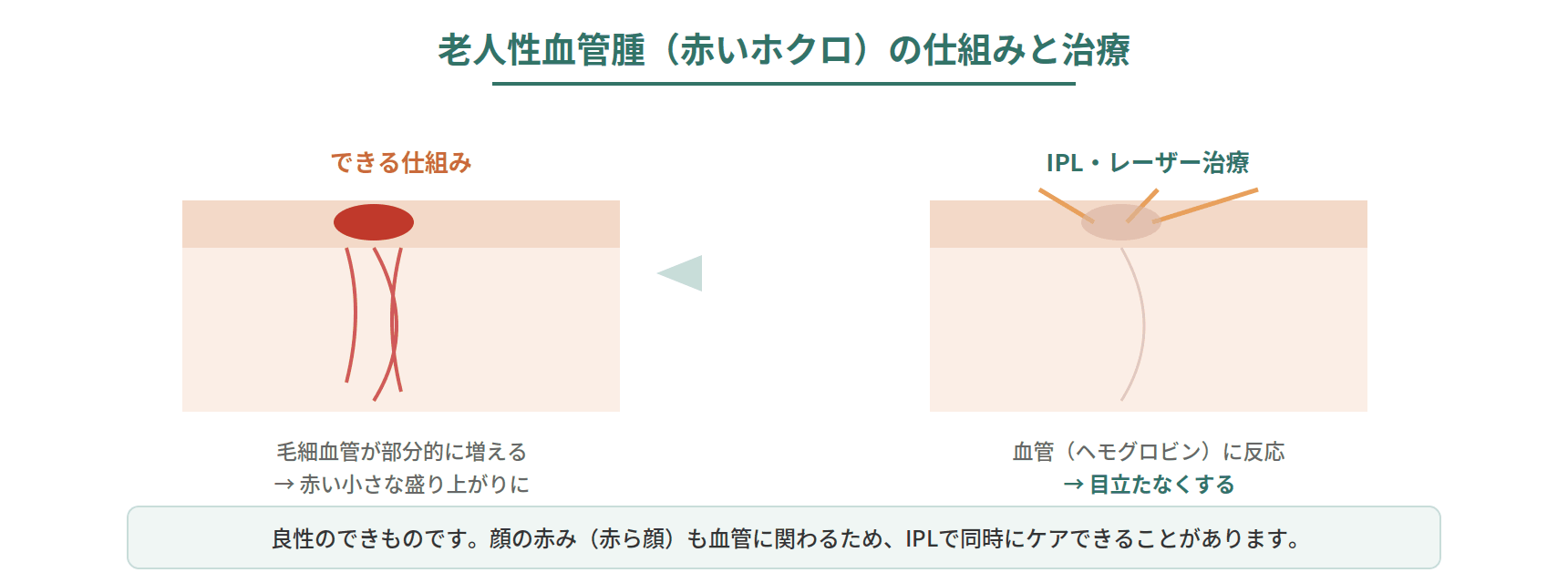 老人性血管腫（赤いホクロ・チェリースポット）が皮膚の毛細血管の増殖でできる様子と、IPLで血管に反応させて目立たなくする仕組みを示した図