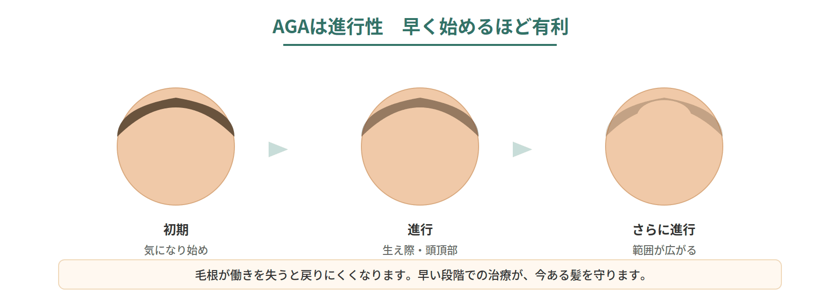 AGAが生え際や頭頂部から進行する様子と、早く治療を始めるほど今ある髪を守りやすいことを示した図